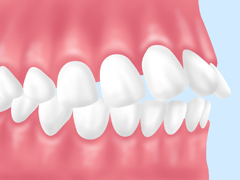 すきっ歯、出っ歯のお悩み